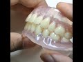 Full Set Dentures by Prof Dental Lab with 25 years experience, Online Order: www.rosenthaldent.com