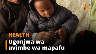 Ugonjwa wa uvimbe wa mapafu ambao husababisha maafa tiba ikichelewa