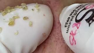 Popping Pimples And Blackheads//35