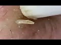 blackheads removal acne treatment and very satisfying satisfying pimple pop blackheads