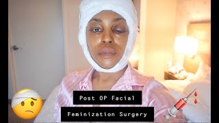 Post Op Facial Feminization Surgery