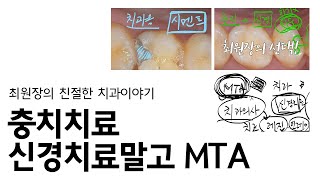 MTA를 이용한 충치치료