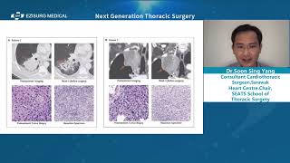 【Ezisurg Medical Webinar】Next Generation Thoracic Surgery