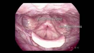 flexible laryngoscopy