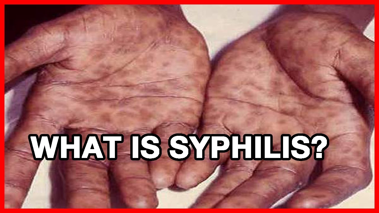 What Is Syphilis? - YouTube