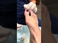 Aspiration of a cyst in the foot