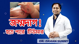 জন্মদাগ!! হতে পারে টিউমার, প্রয়োজন হতে পারে প্লাস্টিক সার্জারী। Dr.Zaman Sunny