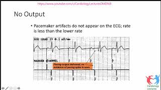 Pacemaker Troubleshooting Dr Amit Malviya