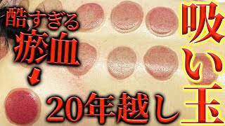 【吸い玉　瘀血】20年以上固い首肩が瘀血でヒドイ吸い玉痕　長い鍼で緊急治療です自宅でできる方法もお伝えします【東京銀座　横浜元町　美容鍼】