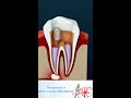 root canal treatment u0026 tooth abscess