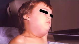 mumps vaccine