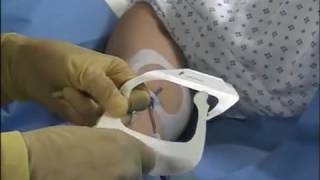 3M™ Tegaderm™  IV Dressing 1688 Application and Removal