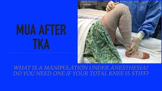 Manipulation Under Anesthesia (MUA) after Total Knee - Treatment for Stiffness