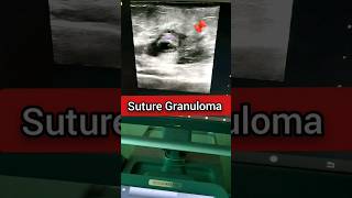 Suture Granuloma | Scar Infection | Infected Silk Suture #medical #shorts #ultrasound #radiology