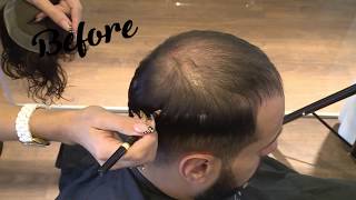 תוספות שיער לגברים - פתרון מושלם לדלילות שיער