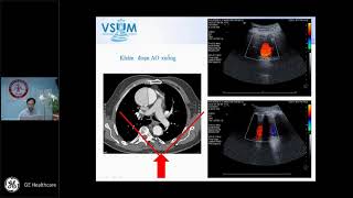 [CME SAMM] 5.1 Siêu âm động mạch chủ ngực và động mạch chủ bụng - PGS.TS Nguyễn Phước Bảo Quân