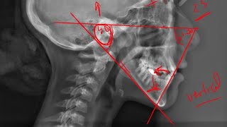 12 -Tweed triangle (Cephalometric analysis)