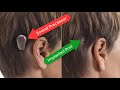 single sided deafness solutions cros bicros baha hearing aids