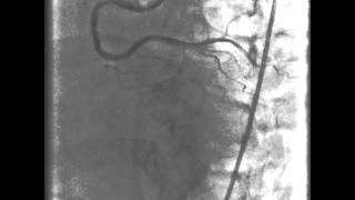 Il trattamento per infarto miocardico acuto