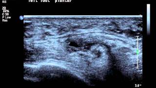 intermetatarsal bursa ultrasound.avi