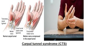 Carpal tunnel syndrome (CTS) / ହାତର ପାପୁଲି ଏବଂ ଆଙ୍ଗୁଠିର ଅସ୍ଥିରତା, ଝିମଝିମ ଏବଂ ଯନ୍ତ୍ରଣା