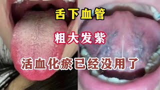 舌下血管粗大发紫 活血化瘀已经没用了