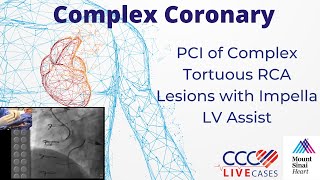 PCI of Complex Tortuous RCA Lesions with Impella LV Assist - October 16, 2012 Webcast Video