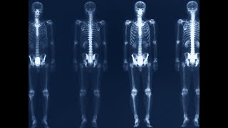 Vegan's X-Ray Showed Transparent Bones