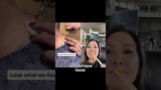 There’s a piece of metal in your neck 🤕 #drpimplepopper #shorts