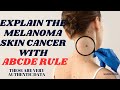 The ABCDE of melanoma skin cancer