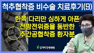 척추협착증 비수술 치료후기, 한쪽 다리가 심하게 아픈 전방전위증을 동반한 추간공협착증 재활치료후기