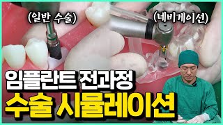 임플란트 과정 실제로 보여드릴게요 (일반 수술 vs 네비게이션 비교)