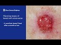 basal cell carcinoma symptoms diagnosis treatment mass general brigham