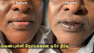 உதடு வெண்புள்ளி நோய்க்கான நிரந்தர தீர்வு | தேமல் | Lip vitiligo treatment| +91 9659959593