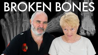 Accidents \u0026 Injuries Abroad (Hiking with a Broken Foot) | Travel \u0026 Sailing Ep 287