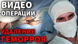 ГЕМОРРОИДЭКТОМИЯ | Удаление геморроя | Операция Миллигана - Моргана