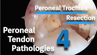 腓骨筋腱障害に対する鏡視下手術４ -腓骨筋滑車の切除- 　Arthroscopic Resection for Peroneal Trochlea