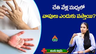 చేతి వేళ్ల మధ్యలో వాపులు ఎందుకు వస్తాయి? | PMC Health