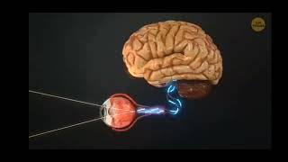 How keratoconus distrupts human vision?_M Agung Candra F_XII MIPA 1_