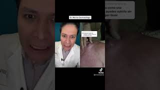 ABSCESO DRENADO: DERMATÓLOGO OPINA