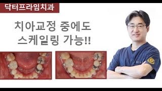 [치아교정] 치아교정 중에도 스케일링 가능!!