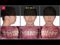 Anterior Open Bite｜【Chris Chang Ortho】CC531