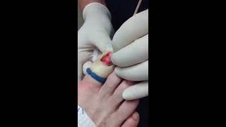 Deformed and incurvated toenail permanently removed!