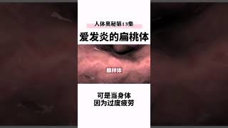 『医学科普』扁桃体发炎的原因~