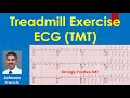 Treadmill Exercise ECG