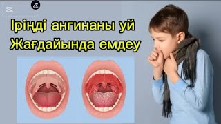 Ангинаны тез емдеу жолы/Ангинаны уй жағдайында емдеу.