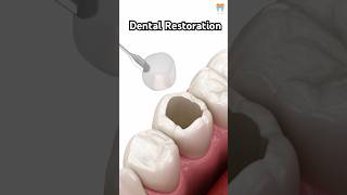 🦷 Dental Restoration ↪ Composite Bonding Teeth ↪ 3D Medical Animation