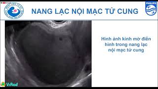 Philips webinar: Những đặc trưng trên siêu âm của một số u buồng trứng