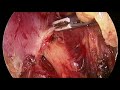 step by step demonstration of laparoscopic pelvic lymph node dissection in rectal cancer