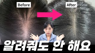 찐으로 효과 본 가르마탈모 관리법 💆🏻‍♀️